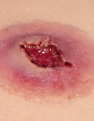 Gunshot back wound - large