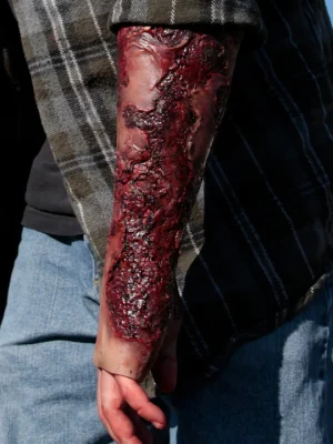 Severe burn forearm (left)