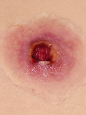 Gunshot back wound - small