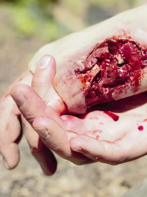 Gunshot wound through hand (left)