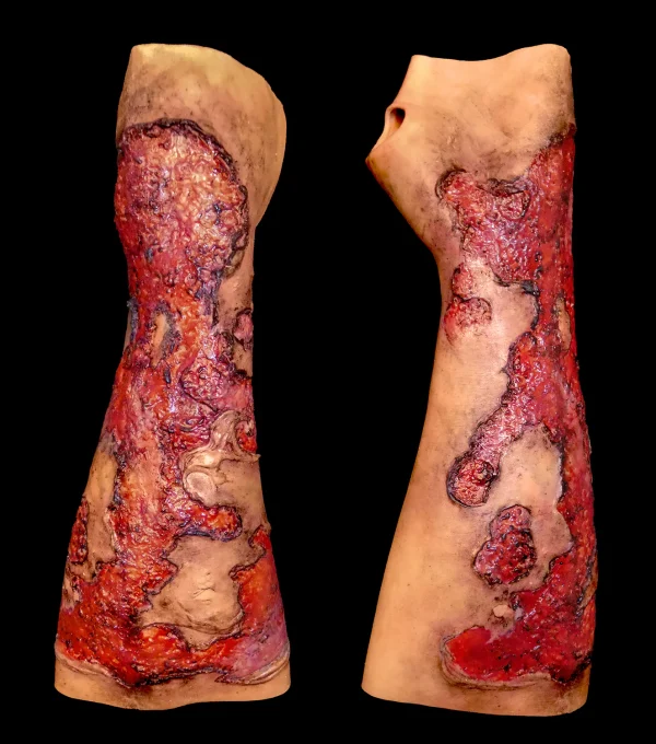 Severe burns forearm (left)