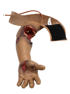 Partial arm amputation (left)