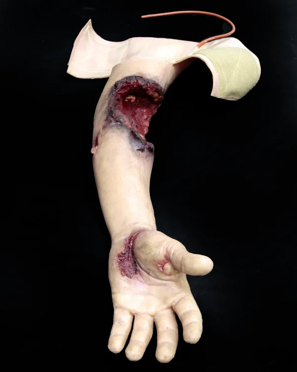 Partial arm amputation (right)