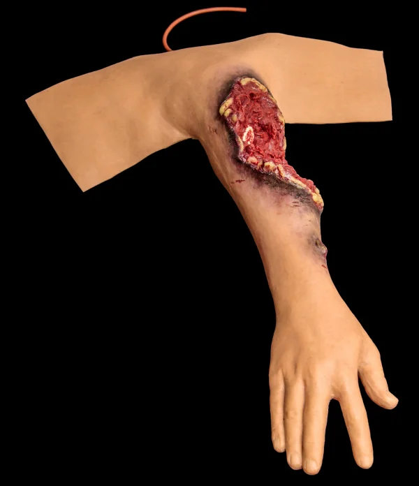 Partial arm amputation (left)