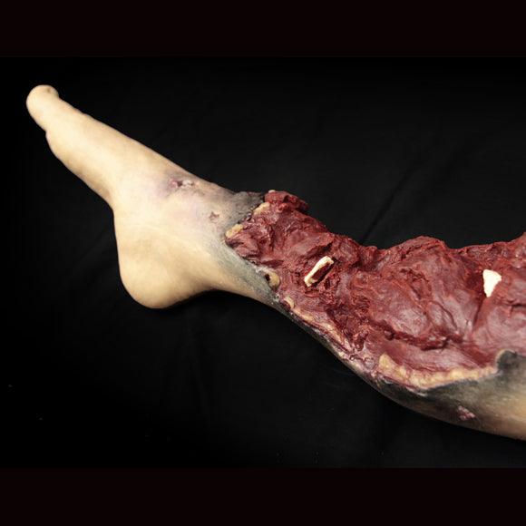 Partial leg amputation (left)
