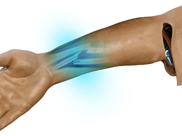 Closed arm fracture (Left arm)