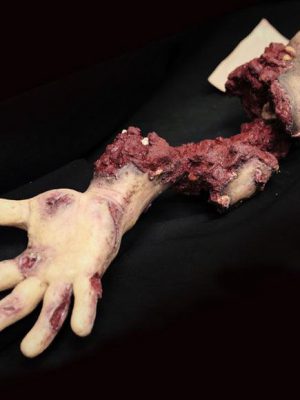 Partial arm amputation with hard bone (right)