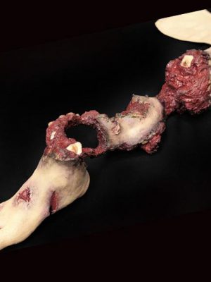 Partial leg amputation with hard bone (right)
