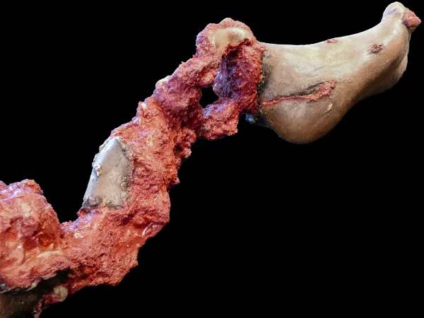 Partial leg amputation with hard bone (right)
