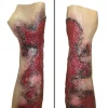 Severe burns forearm (right)